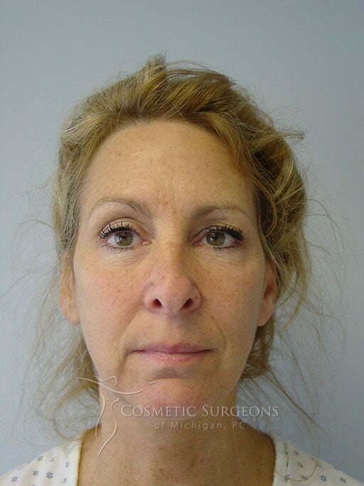 Chin Implant patient 2830