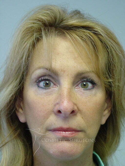 Chin Implant patient 2830