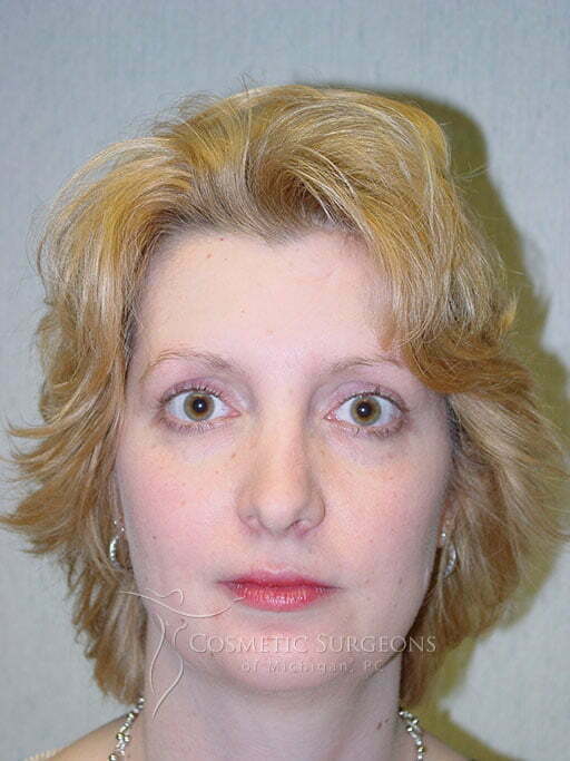 Chin Implant patient 2841