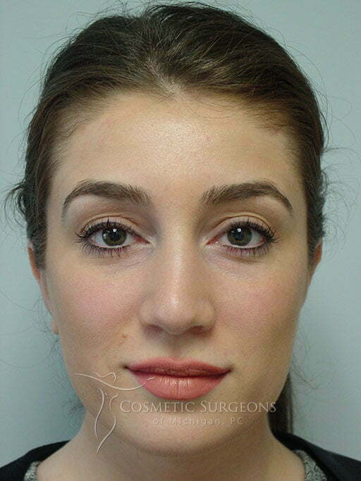 Otoplasty patient 3396