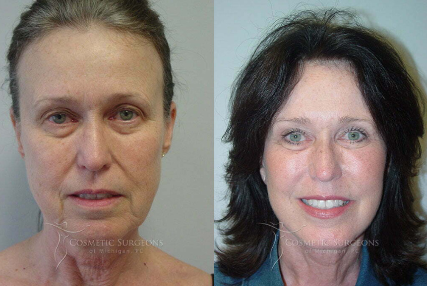 Female facelift patient shown before and after facelift with Detroit facial cosmetic surgeon Dr. George Goffas