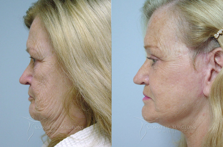 Woman shown before and after facelift with a neck lift and upper eyelid lift with Detroit facial cosmetic surgeon Dr. George Goffas