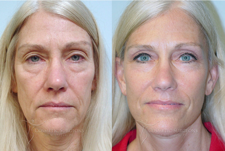 Female facelift patient shown before and after facelift with Detroit facial cosmetic surgeon Dr. George Goffas