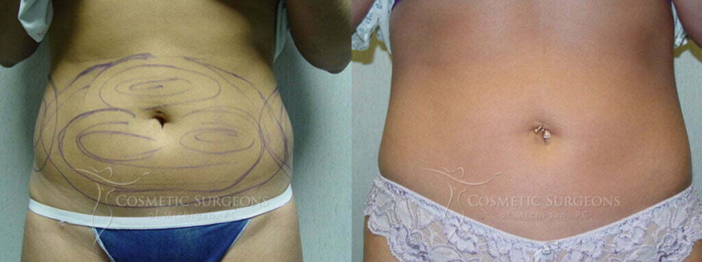 Female patient of Dr. George Goffas shown before and after liposuction