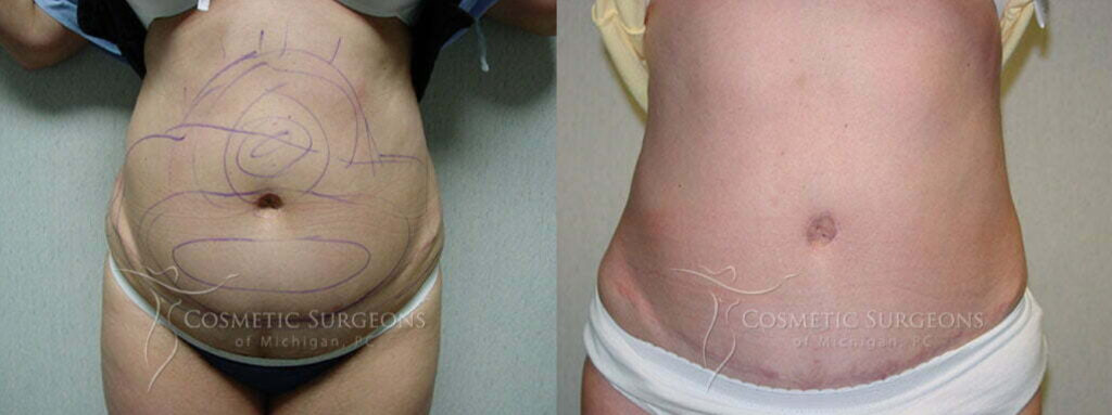 Female patient of Dr. George Goffas shown before and after liposuction to to the stomach and abdomen