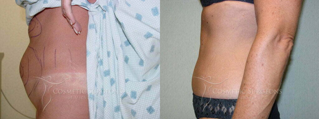 Female patient of Dr. George Goffas shown before and after liposuction to remove fat in the lower stomach